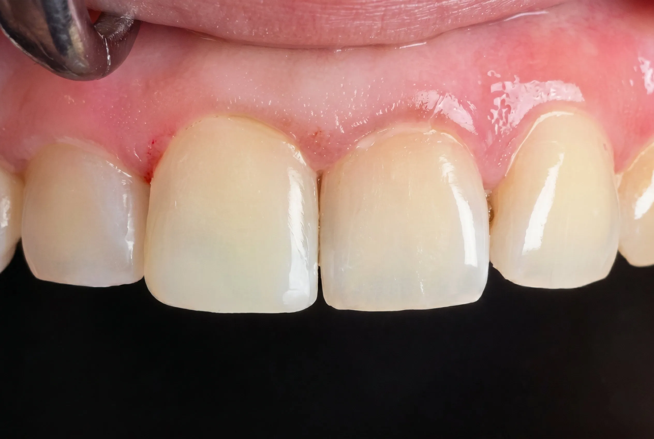 Dental Filling - After